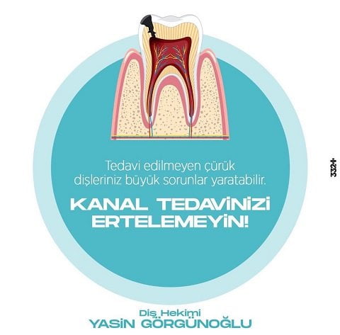 kanal tedavisi resmi