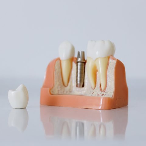İmplant 3D Görsel Kaplama Yapılmamış Hali